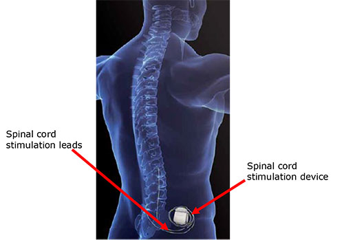 Spinal cord stimulation