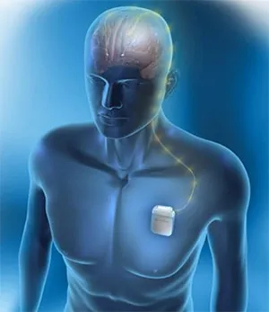 A deep brain stimulation device